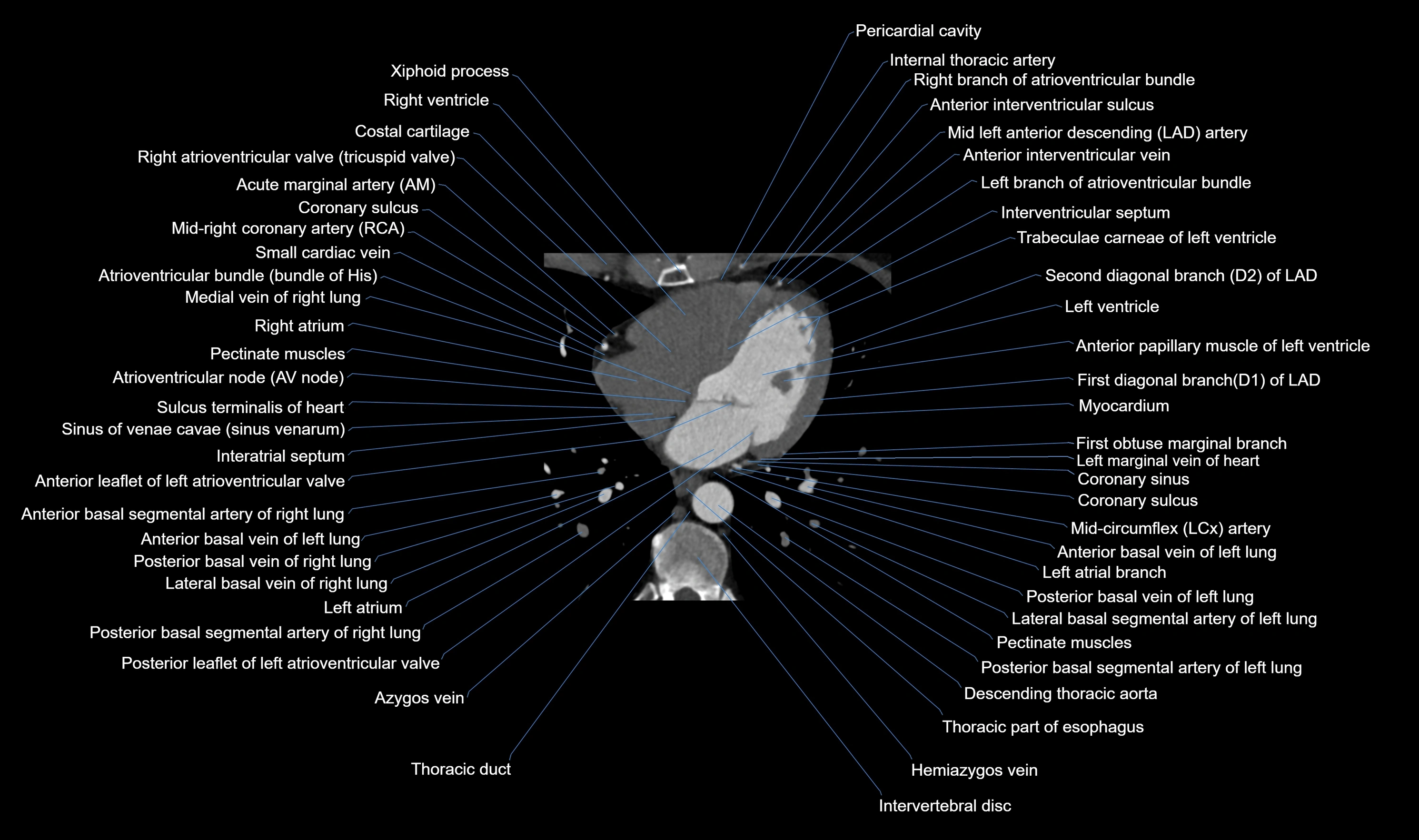 CT heart (coronary angiogram) axial view cross sectional anatomy labelled radiology image-00042.webp